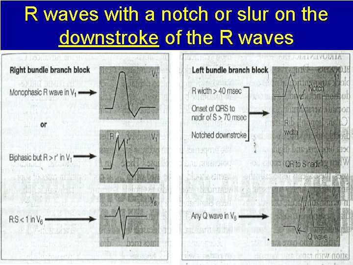 R waves with a notch or slur on the downstroke of the R waves