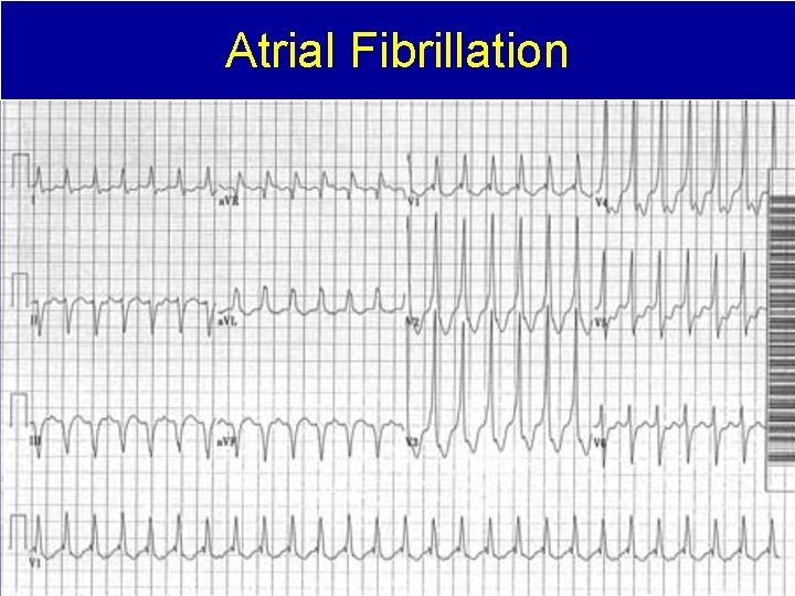 Atrial Fibrillation 