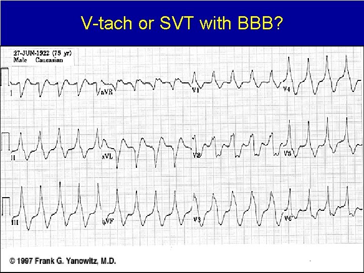 V-tach or SVT with BBB? 