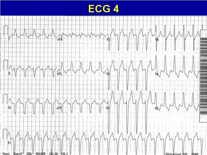 ECG 4 