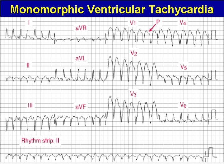 Monomorphic Ventricular Tachycardia 