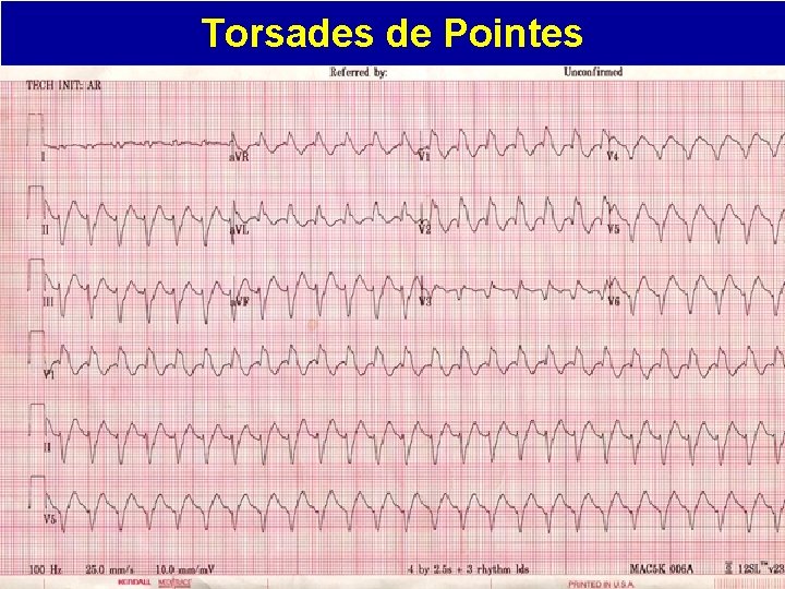 Torsades de Pointes 