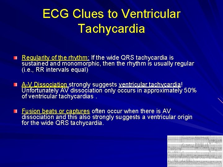 ECG Clues to Ventricular Tachycardia Regularity of the rhythm: If the wide QRS tachycardia