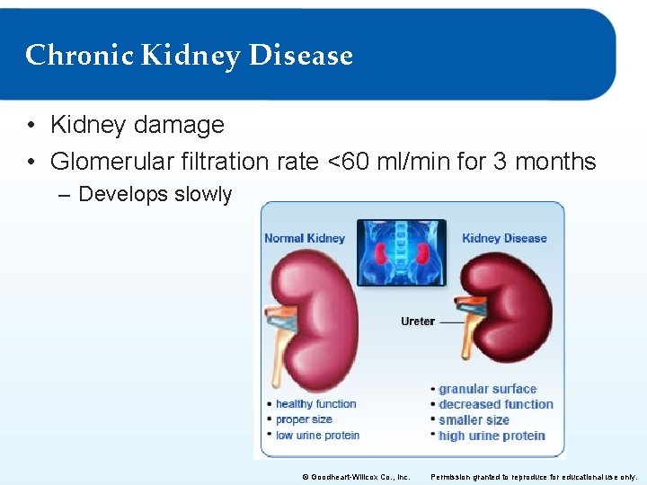 Chronic Kidney Disease • Kidney damage • Glomerular filtration rate <60 ml/min for 3