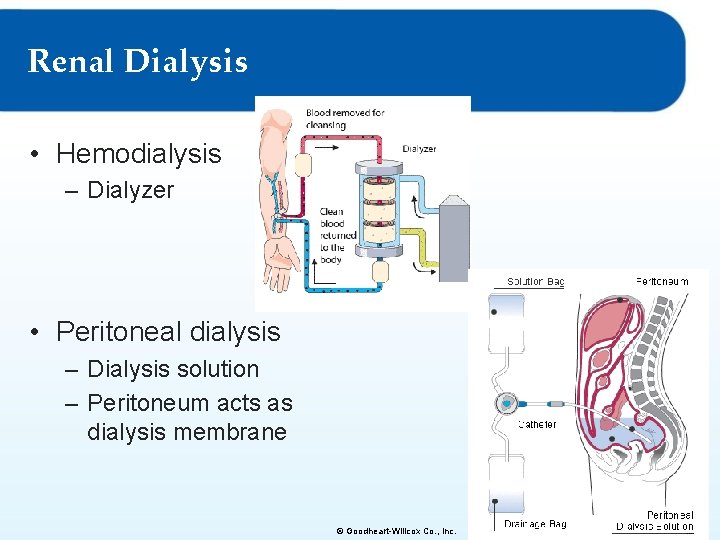 Renal Dialysis • Hemodialysis – Dialyzer • Peritoneal dialysis – Dialysis solution – Peritoneum