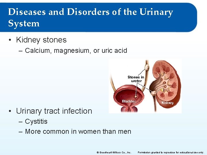 Diseases and Disorders of the Urinary System • Kidney stones – Calcium, magnesium, or