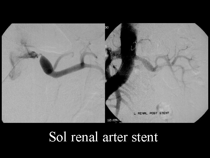 Sol renal arter stent 