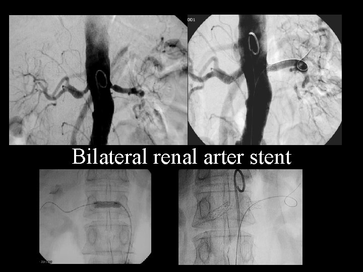 Bilateral renal arter stent 