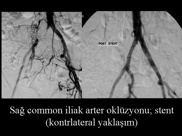 Sağ common iliak arter oklüzyonu; stent (kontrlateral yaklaşım) 