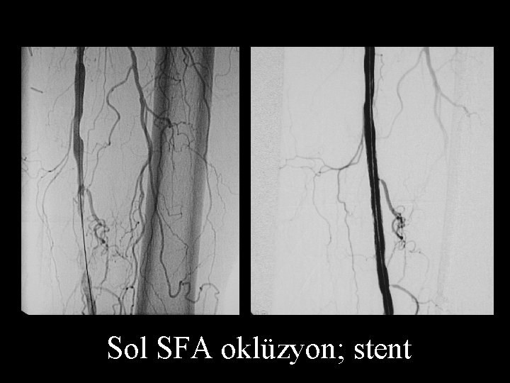 Sol SFA oklüzyon; stent 