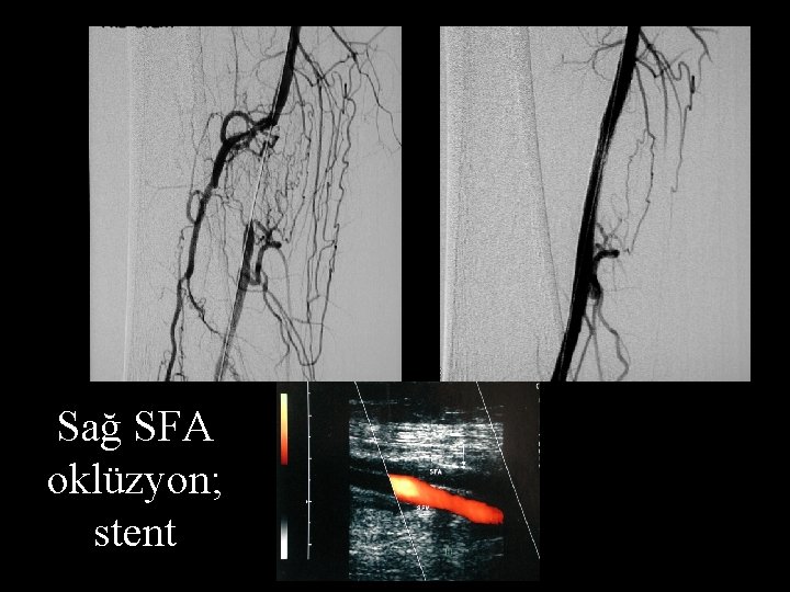 Sağ SFA oklüzyon; stent 