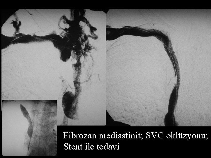 Fibrozan mediastinit; SVC oklüzyonu; Stent ile tedavi 