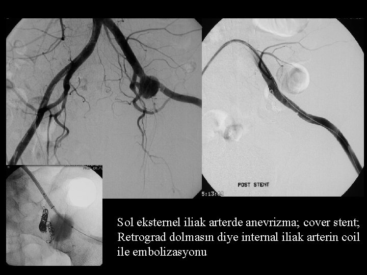 Sol eksternel iliak arterde anevrizma; cover stent; Retrograd dolmasın diye internal iliak arterin coil