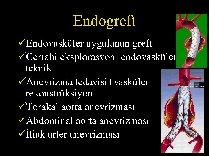 Endogreft üEndovasküler uygulanan greft üCerrahi eksplorasyon+endovasküler teknik üAnevrizma tedavisi+vasküler rekonstrüksiyon üTorakal aorta anevrizması üAbdominal