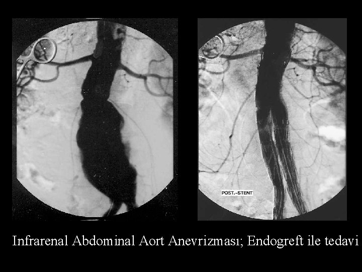 Infrarenal Abdominal Aort Anevrizması; Endogreft ile tedavi 