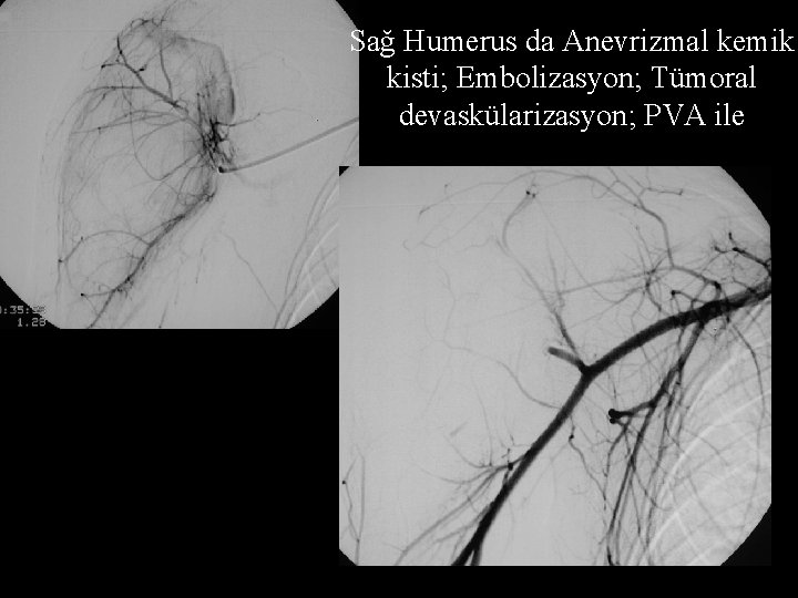 Sağ Humerus da Anevrizmal kemik kisti; Embolizasyon; Tümoral devaskülarizasyon; PVA ile 