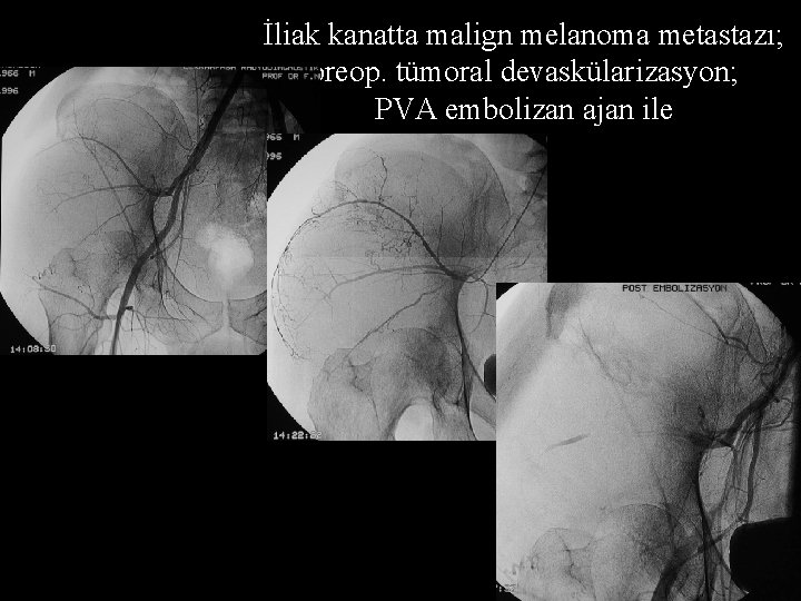 İliak kanatta malign melanoma metastazı; preop. tümoral devaskülarizasyon; PVA embolizan ajan ile 