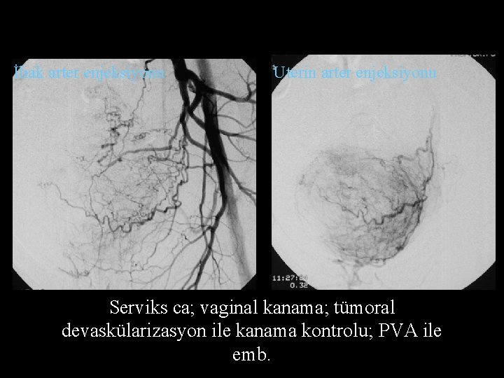 İliak arter enjeksiyonu Uterin arter enjeksiyonu Serviks ca; vaginal kanama; tümoral devaskülarizasyon ile kanama