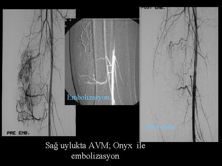 Embolizasyon Post emb. Sağ uylukta AVM; Onyx ile embolizasyon 