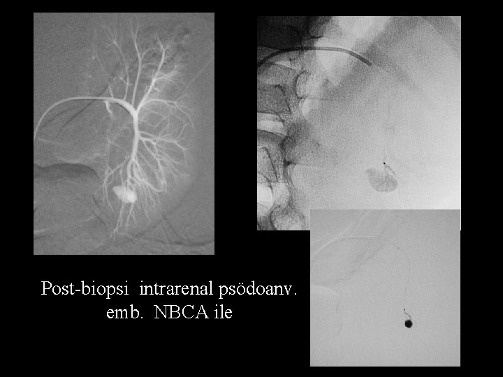 Post-biopsi intrarenal psödoanv. emb. NBCA ile 
