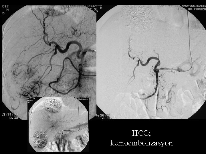 HCC; kemoembolizasyon 