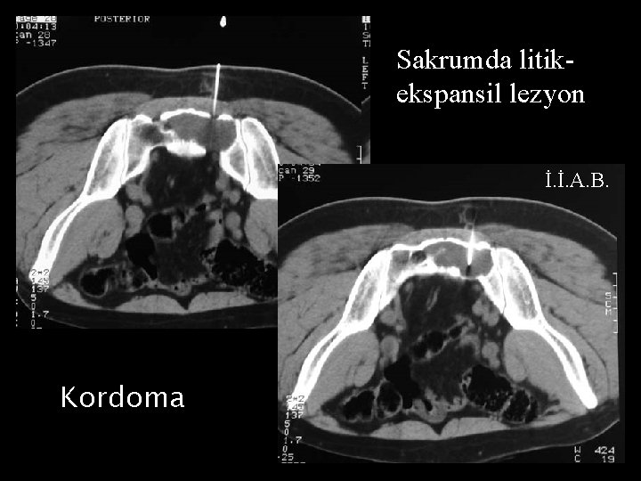 Sakrumda litikekspansil lezyon İ. İ. A. B. Kordoma 