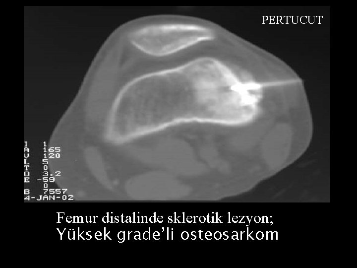 PERTUCUT Femur distalinde sklerotik lezyon; Yüksek grade’li osteosarkom 