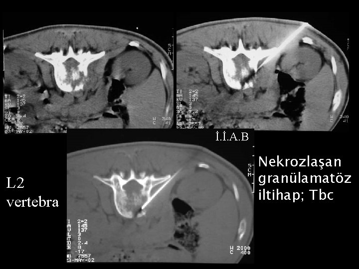 İ. İ. A. B L 2 vertebra Nekrozlaşan granülamatöz iltihap; Tbc 