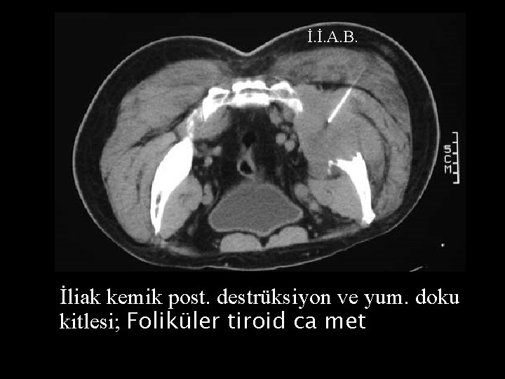 İ. İ. A. B. İliak kemik post. destrüksiyon ve yum. doku kitlesi; Foliküler tiroid