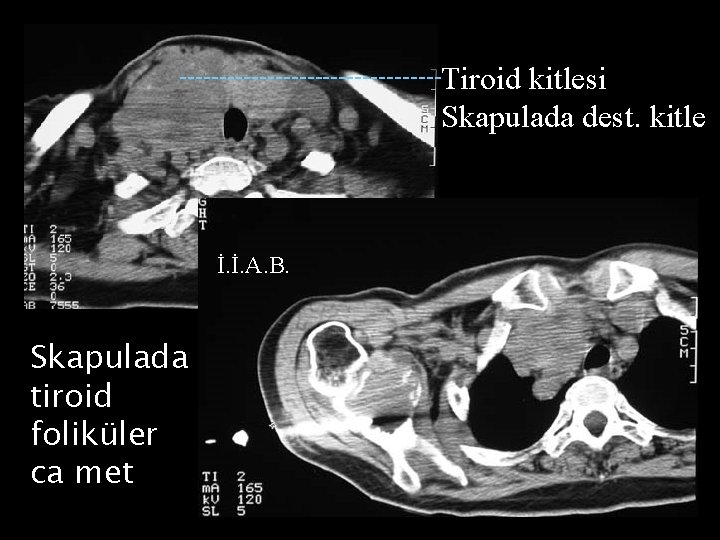 -----------------Tiroid kitlesi Skapulada dest. kitle İ. İ. A. B. Skapulada tiroid foliküler ca met