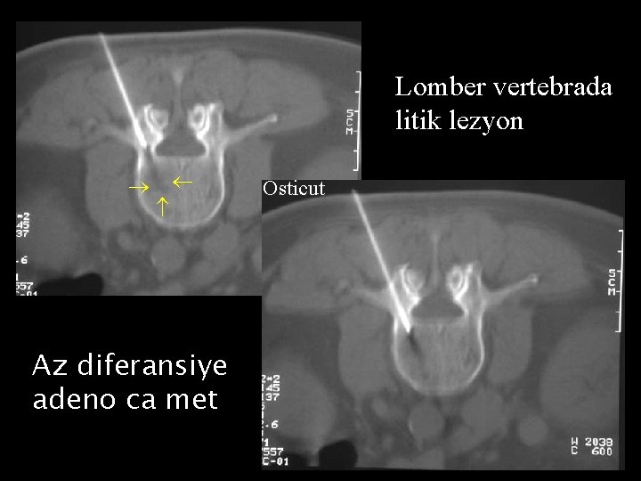 Lomber vertebrada litik lezyon Az diferansiye adeno ca met Osticut 