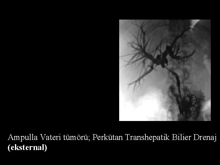 Ampulla Vateri tümörü; Perkütan Transhepatik Bilier Drenaj (eksternal) 