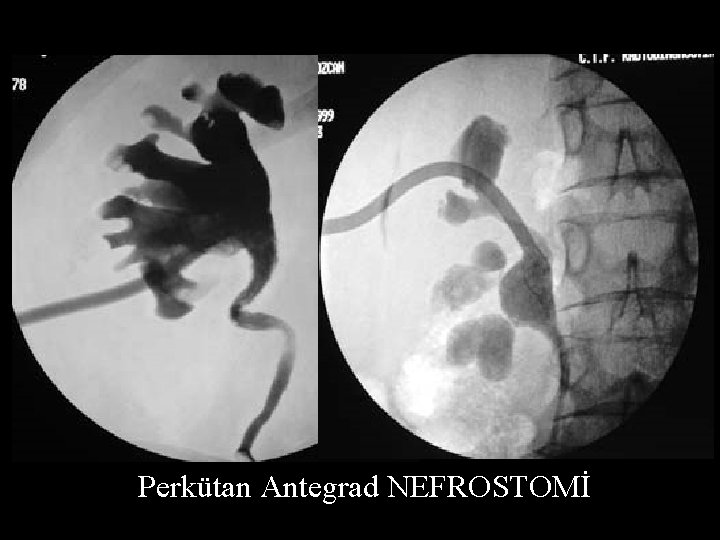 Perkütan Antegrad NEFROSTOMİ 