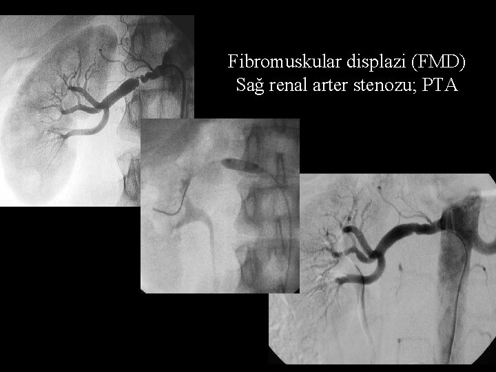 Fibromuskular displazi (FMD) Sağ renal arter stenozu; PTA 