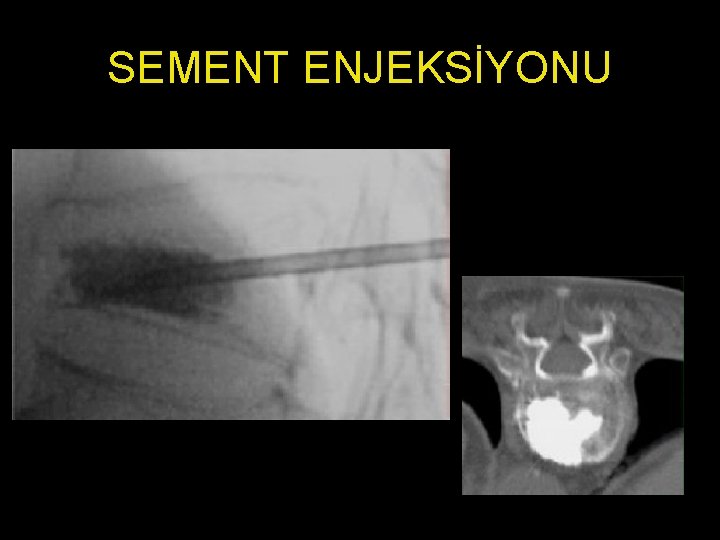 SEMENT ENJEKSİYONU 