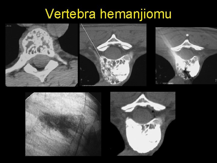 Vertebra hemanjiomu 