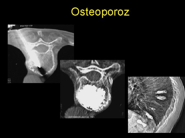 Osteoporoz 