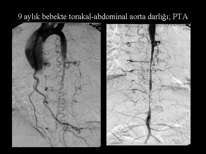 9 aylık bebekte torakal-abdominal aorta darlığı; PTA 