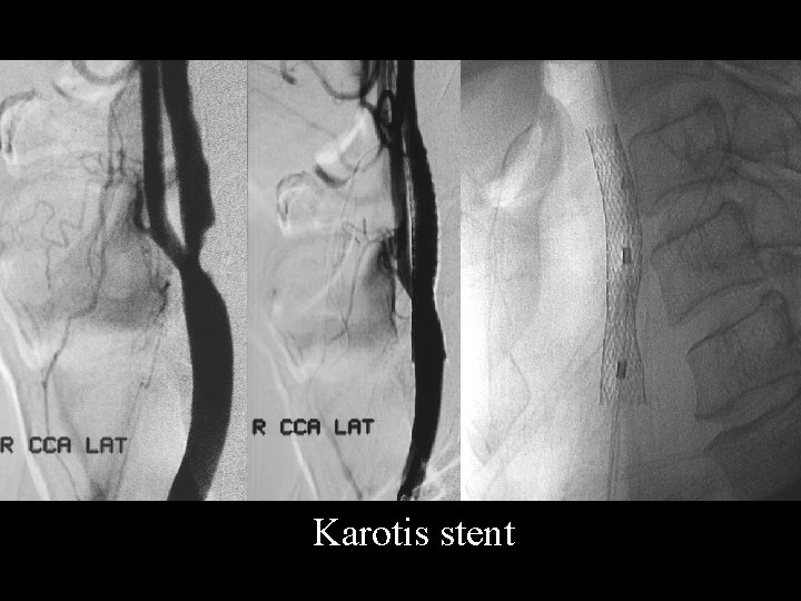 Karotis stent 