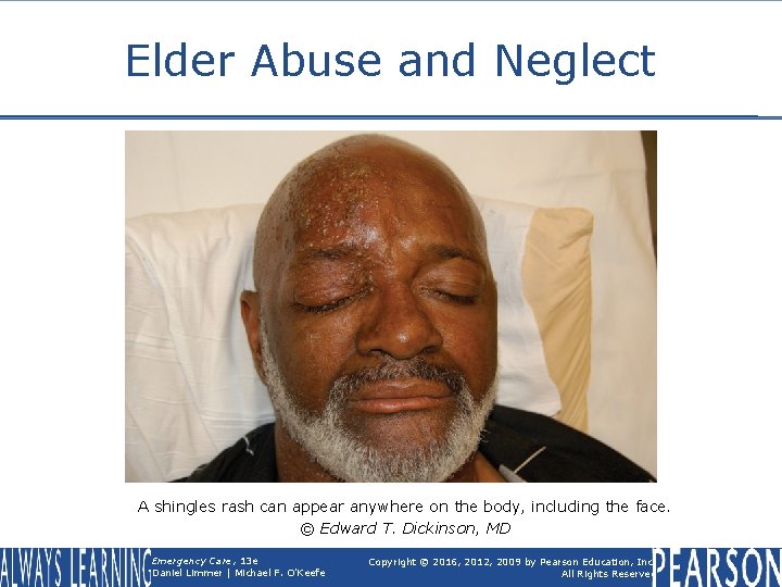 Elder Abuse and Neglect A shingles rash can appear anywhere on the body, including