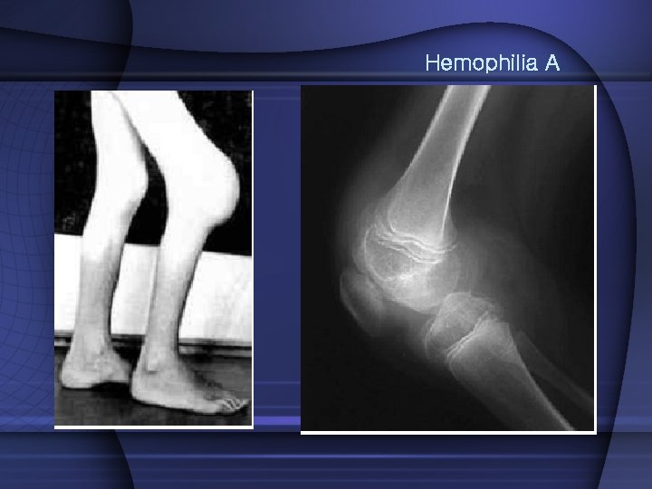 Hemophilia A 