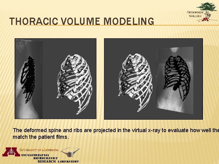 THORACIC VOLUME MODELING The deformed spine and ribs are projected in the virtual x-ray