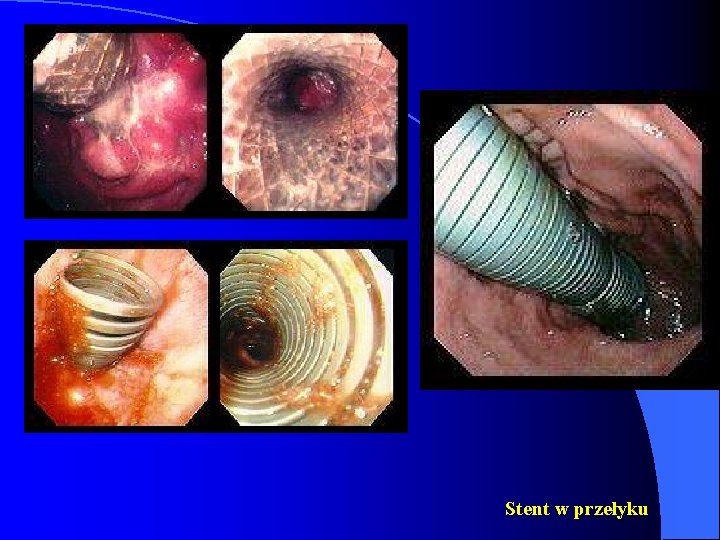 Stent w przełyku 