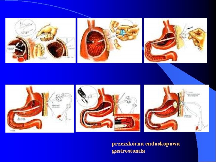 przezskórna endoskopowa gastrostomia 