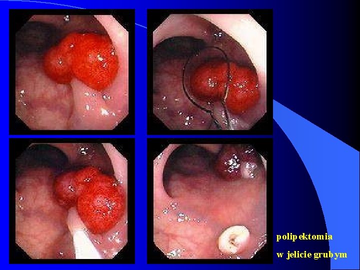polipektomia w jelicie grubym 