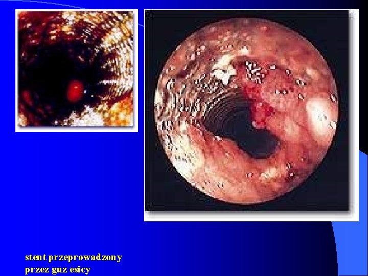 stent przeprowadzony przez guz esicy 