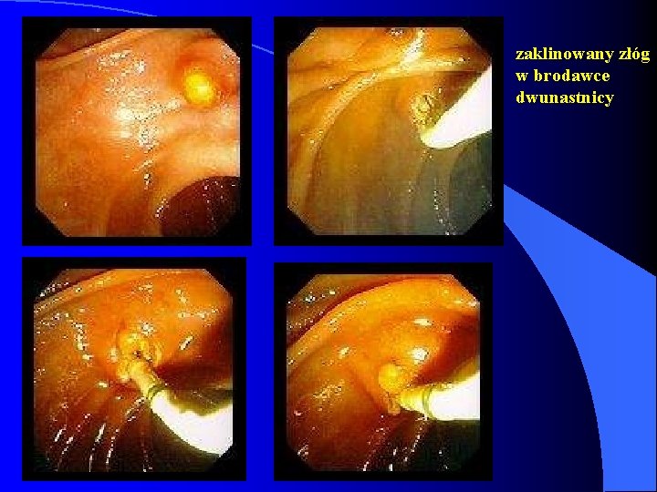 zaklinowany złóg w brodawce dwunastnicy 