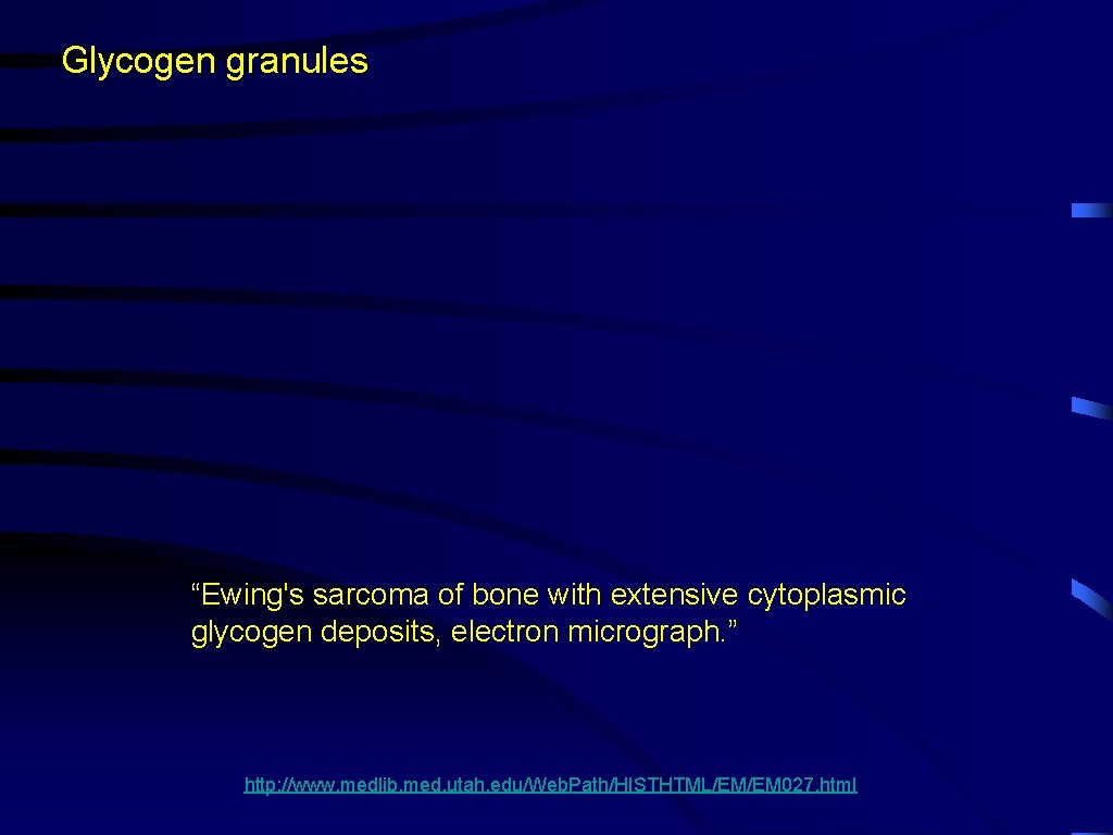 Glycogen granules “Ewing's sarcoma of bone with extensive cytoplasmic glycogen deposits, electron micrograph. ”