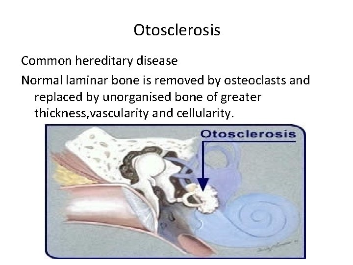 Otosclerosis Common hereditary disease Normal laminar bone is removed by osteoclasts and replaced by
