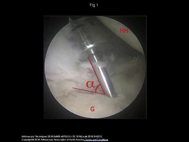 Fig 1 Arthroscopy Techniques 2016 5 e 965 -e 970 DOI: (10. 1016/j. eats.